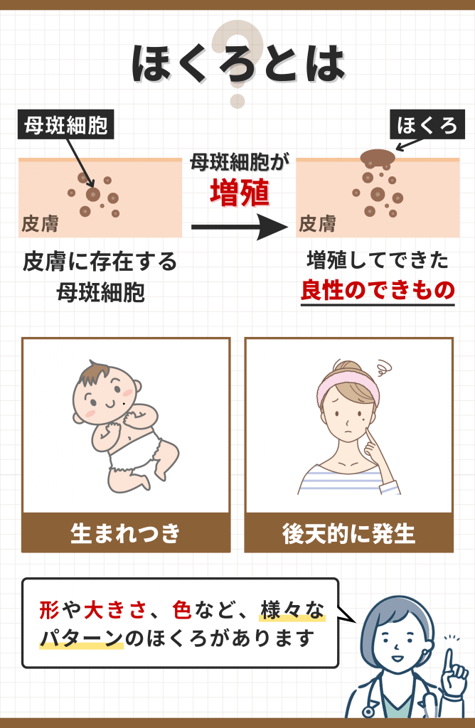 ほくろとは母斑細胞が皮膚で増殖したもの