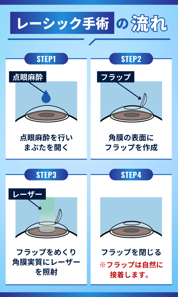 レーシックとは角膜をレーザーで削り、視力を矯正する手術のこと