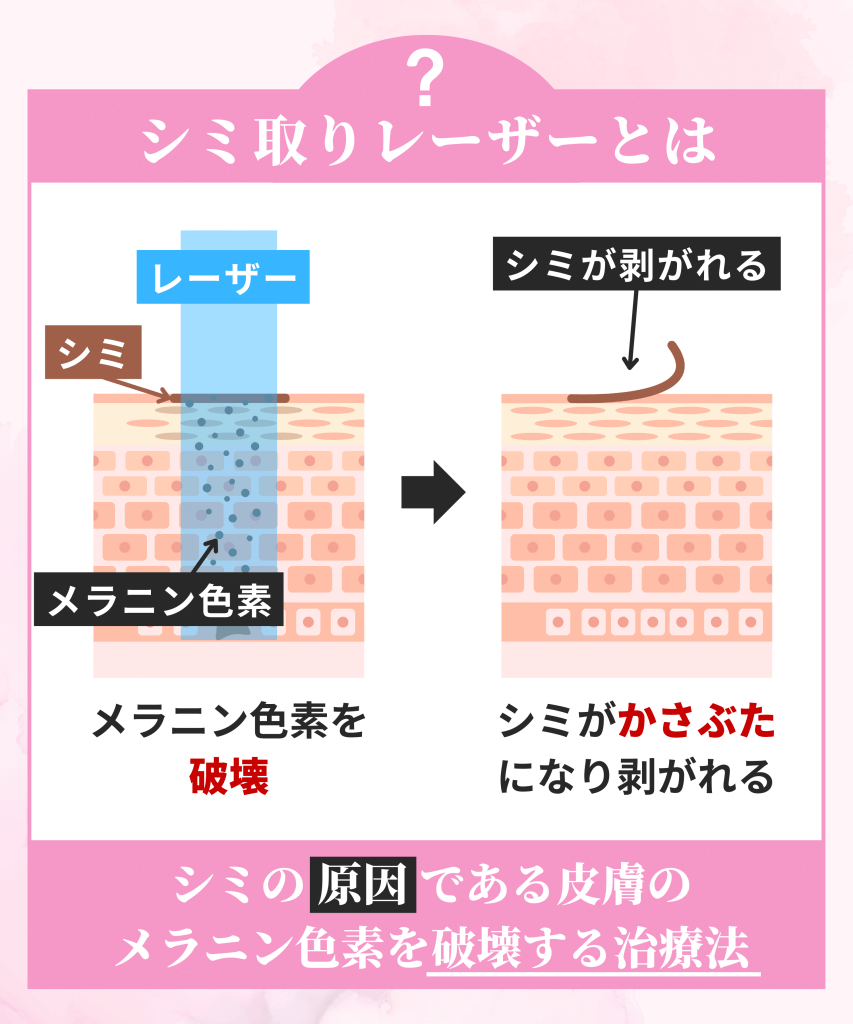 シミ取りレーザーとはメラニン色素を破壊する治療法